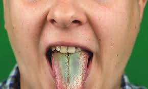 Image result for yellow tongue infection