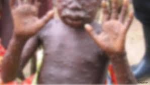 Monkeypox is a viral zoonotic infection that results in a rash similar to smallpox. Gp6 Doglnaibmm