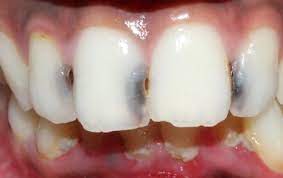 Dental Filling And Tooth Cavity Filling Cost Treatment Causes