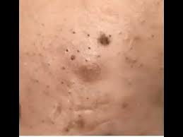 Cystic Acne Pimples And Blackheads Extraction Treatment On Face Part07 Click Here For The Acne No More Program Acne Beauty Tipps Tipps Und Tricks Tipps