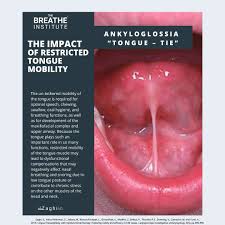Image result for Ankyloglossia