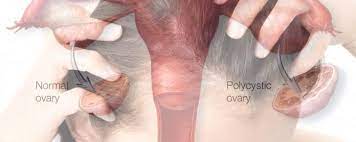 “la caduta dei capelli e dei peli è un effetto collaterale che alcuni trattamenti antitumorali possono dare, come la chemioterapia e la . L Associazione Tra Ovaio Policistico E Perdita Di Capelli Nelle Donne