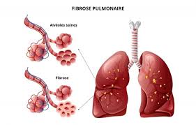 La fibrose pulmonaire, qu'est-ce que c'est ?