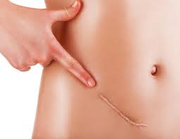 An ovarian cyst can be composed of endometriosis—this specific type of cyst is called an endometrioma—but a simple ovarian cyst tends to go away after four to eight weeks, she says. Endometriosis Delayed Diagnosis Impacts Disease Management And Patient Well Being