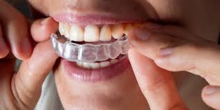 Many orthodontist offices offer payment plans to make it easy to cover the cost of your invisalign. Invisalign Vs Braces Cost Effectiveness And Appearance