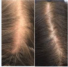 Susan bard ( dermatologist ), manhattan dermatology specialists manhattan dermatology locations: Prp For Hair Loss Nyc Dennis Gross Md Dermatology