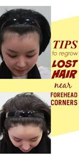 Biotin Oil For Hair Growth Results 10 Effective Home Remedies For Hair Loss Near Forehead Corners In 2020 Home Remedies For Hair Hair Loss Control Lost Hair