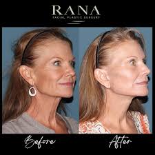 Dr. Nik Rana (@ranafacialplasticsurgery) • Instagram photos and videos