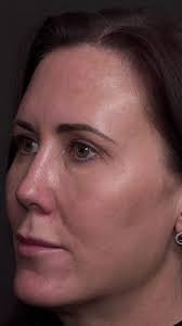 Understanding Facial Structure to Enhance Eye Beauty