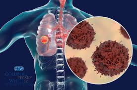 Affects mostly older individuals who have been occupationally exposed to asbestos. Signs And Symptoms Of Mesothelioma Goldberg Persky White P C