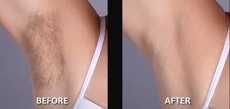 Laser hair removal in barrie, on. Painless Laser Hair Removal Ice 21