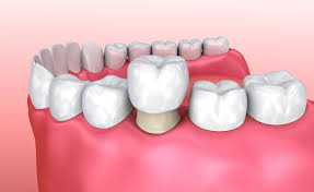 Dental Crowns | The Full Procedure Explained