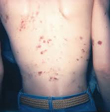 The face and neck may be affected as well. Purpura And Other Hematovascular Disorders Sciencedirect