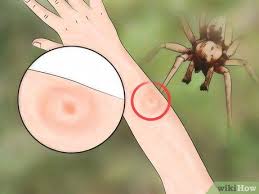 Image result for spinne biss haut reaktion