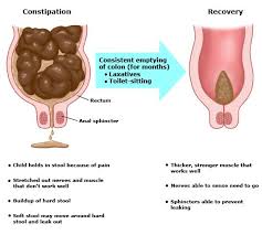 Image result for Functional Encopresis