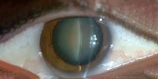 A cataract is a clouding of the eye's natural lens, which lies behind the iris and the pupil. Post Cataract Surgery A Post Operative Care Guide