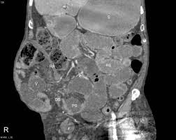 She wasn't able keep anything down, food or water just came back up. Approach To The Patient With Intestinal Obstruction Cancer Therapy Advisor