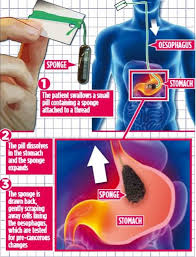 Anemia is one of the most common signs of advanced cancer. New Sponge On A String Test Can Pick Up Early Signs Of Oesophageal Cancer Australiannewsreview