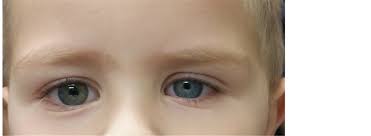 Clinical Presentations Of Pediatric Horner Syndrome