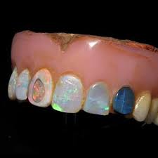 Opal Dentures Teeth Weird And Wonderful Dental Art Opal