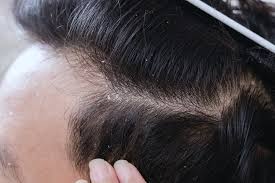 Once this is done, you can apply this on your scalp and massage your hair gently with it. How To Get Rid Of Dandruff