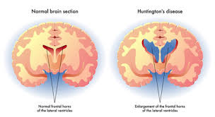 Boala Huntington Coreea Huntington Simptome Tratament Newsmed Ro