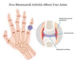 Every case is different, but there is a general pattern in the way ra progresses. Rheumatoid Arthritis Early Signs Causes And Treatment