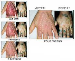 Tattoo Removal