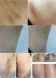 Bikini laser hair removal traditionally removes only the hair that is visible around the bikini area. China Factory Oem Salon Lightsheer Soparano Brazilian Hair Removal Laser Treatment Medical Equipment China Laser Medical Equipment Medical Equipment Made In China Com