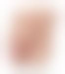 Image result for paraphimosis