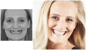 Zoe dental implants case study