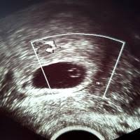 Hallo ich habe das mal eine frage: Ssw 7 0 Kein Embryo Kein Herzschlag Forum Schwanger Ab 35 Urbia De
