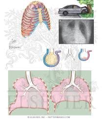 Image result for Pulmonary Contusion