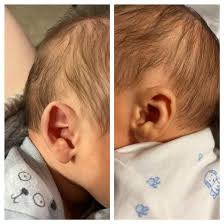 My newborn son has completely different shaped ears. : r ...