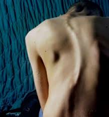 Scoliosis Setting The Record Straight People with scoliosis should stay active and keep a healthy weight. scoliosis setting the record straight