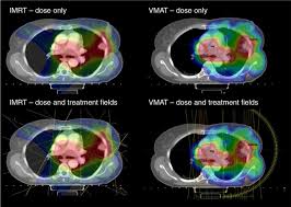 I have stage 4 lung cancer, but i don't plan to die from it. Practical Implications To Contemplate When Considering Radical Therapy For Stage Iii Non Small Cell Lung Cancer British Journal Of Cancer