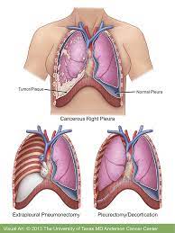 Mesothelioma is an aggressive cancer caused by asbestos exposure. Mesothelioma Asbestos Cancer Md Anderson Cancer Center