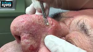 When it comes to pimple popping videos on youtube, you're either intrigued and satisfied or totally horrified. The 15 Best Pimple Popping Videos On Youtube