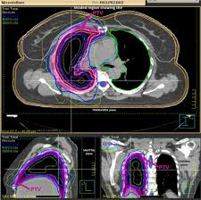Trials allow researchers test new. Complex Target Volume Delineation And Treatment Planning In Radiotherapy For Malignant Pleural Mesothelioma Mpm