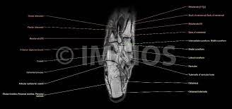 Piriformis syndrome is a condition characterized by sciatic symptoms (leg pain) due to extrapelvic sciatic nerve compression at the hip. Anatomy Of The Foot And Ankle Mri