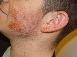 Bakterien sind einzeller, die teilweise erkrankungen beim menschen auslösen können. Was Sind Die Ersten Symptome Von Mrsa