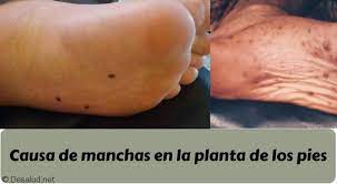 Manchas En La Planta De Los Pies Causas Sintomas Y Tratamientos Tu Blog De Salud Y Medicina