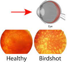 Birdshot Chorioretinopathy Wikipedia