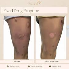Image result for Fixed Drug Eruption