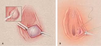 Image result for Bartholin's gland abscess