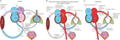 Image result for Delayed Transition from Fetal Circulation