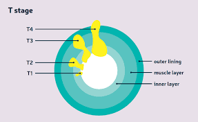 Doctors use a system called staging to figure out how the cancer. Staging Grading Diagnosis About Bowel Cancer Bowel Cancer Uk