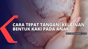 Kelainan bawaan pada kaki seperti clubfoot. Ketahui Penyebab Dan Cara Tepat Tangani Kelainan Bentuk Kaki Pada Anak Youtube