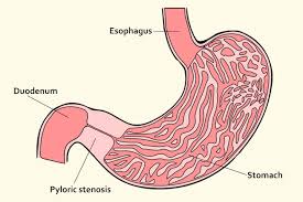 Pyloric Stenosis Causes Symptoms And Treatment