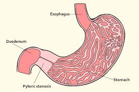 pyloric stenosis causes symptoms and treatment